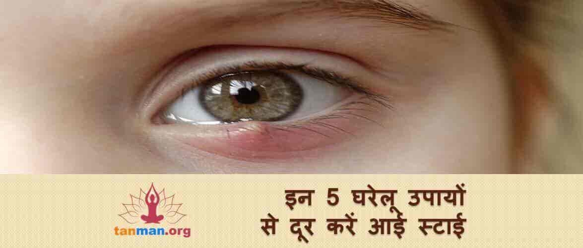 इन 5 घरेलू उपायों से दूर करें आई स्टाई