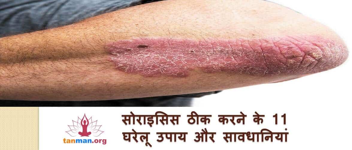 सोरायसिस में बहुत काम आएंगे ये 11 घरेलू नुस्खे और सावधानियां