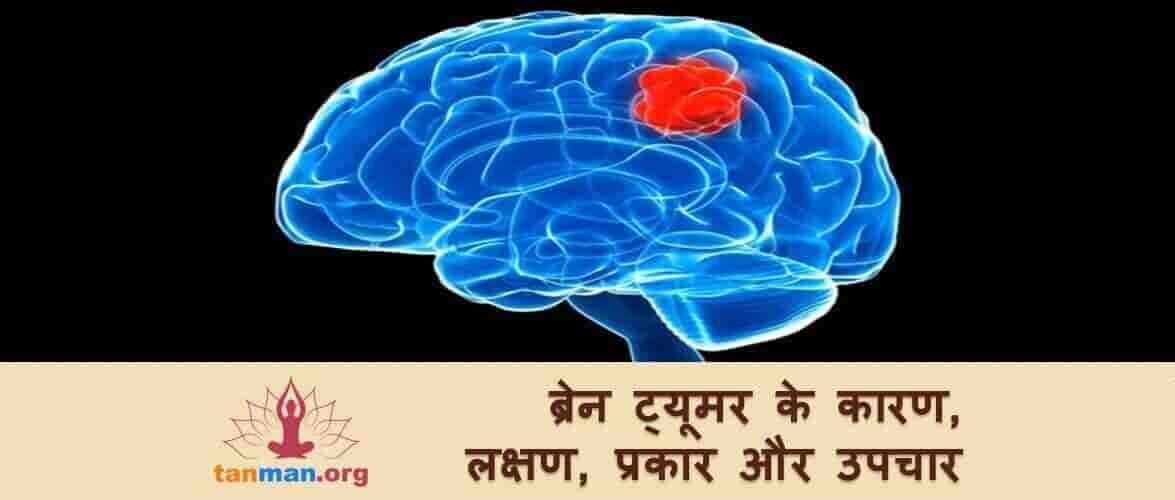 हल्के में न लें ब्रेन ट्यूमर के खतरे को, जानिए इसके कारण, लक्षण, प्रकार और उपचार