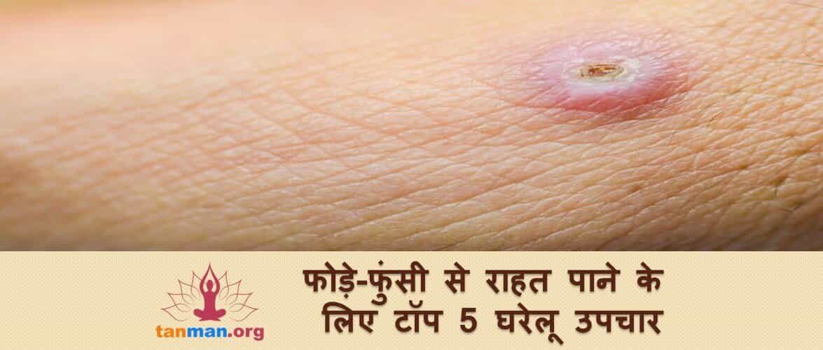 फोड़े से राहत पाने के टाॅप 5 घरेलू उपचार